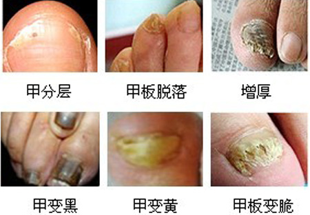 灰指甲图片-灰指甲早期症状